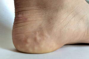 علت برجستگی های سفید روی پاشنه پا ( پاپول پیزوژنیک ) چیست ؟