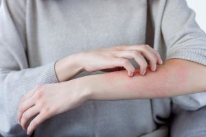 این رژیم غذایی باعث ایجاد عارضه کتو راش می شود