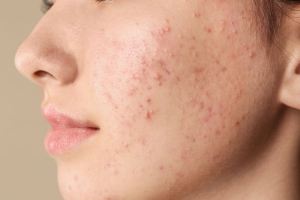 این موارد باعث ایجاد جوش های گوارشی و مشکلات پوستی می شود