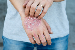علت حساسیت ، خارش پوست و آلرژی به بدلیجات چیست؟