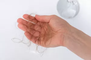 درمان ریزش موی آندروژنیک یا از دست دادن ارثی مو