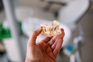 طول عمر روکش ایمپلنت دندان چقدر است؟