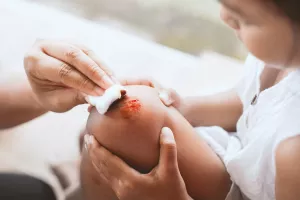 درمان اضطراری زخم و بریدگی عمیق روی پوست کودکان