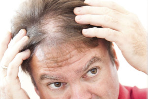 ریزش مو چه ارتباطی با چاقی دارد؟
