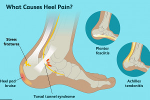 علت درد پاشنه پا و ۱۰ روش خانگی برای درمان آن
