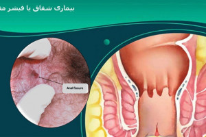 آیا شقاق یا فیشر مقعدی نیاز به درمان دارد؟