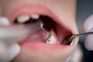هزینه پرکردن دندان در سال ۱۴۰۲