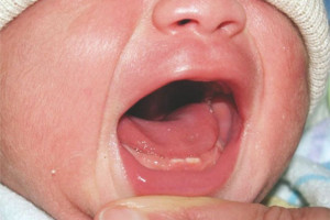 دندان ناتال یا دندان های نوزادی چیست ؟