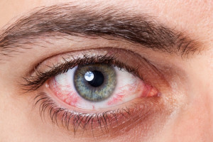 راههای پیشگیری و علائم آلرژی چشم