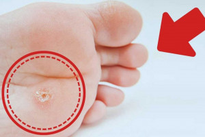 زگیل کف پا چیست و چه علائمی دارد ؟