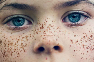 علائم ملاسما چه کسانی به ملاسما مبتلا می شوند ؟