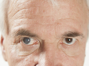آب مروارید چشم چیست؟علائم آب مروارید چشم کدام است؟درمان آب مروارید چشم