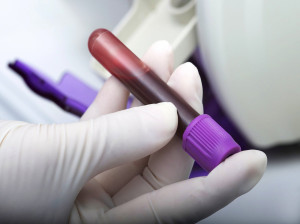 علل کاهش گلبول‌های سفید خون چیست؟