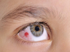  علتهای رایج لکه های خونی داخل چشم و درمان