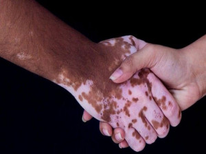 حکم ازدواج با کسی که بیماری پیسی دارد و نگفته است!