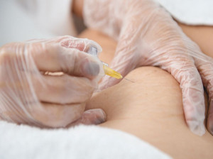 کاربرد کربوکسی تراپی در کاهش وزن