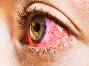 قرمزی چشم چیست و علل به وجود آمدن و راه های درمان آن چیست ؟
