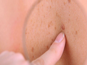 سرطان سلول‌های ملانوما پوست چه دلایلی دارد؟