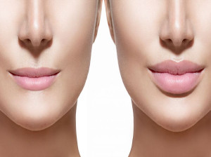 لیفت لب با نخ و همه آن چه که باید در مورد آن بدانید ! سانترال لب بالا چیست؟