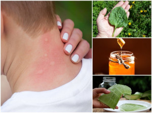 ۱۵ راه خانگی با مواد غذایی برای درمان گزش پشه