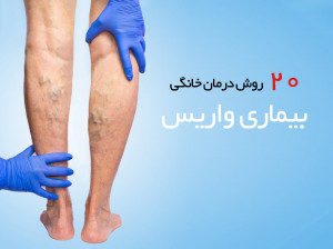درمان واریس: ۲۰ درمان خانگی رگ های واریسی