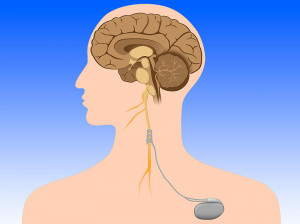 فرآیند تحریک عصب واگ چیست؟