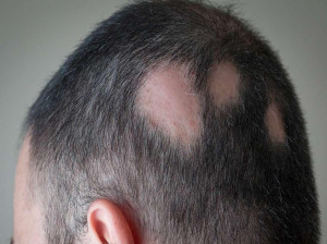 فواید تزریق تریامسینولون در سر برای درمان ریزش مو