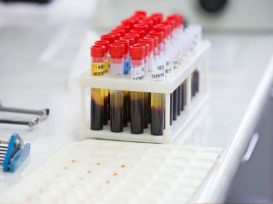 علت درخواست آزمایش آمیلاز (Amylase)