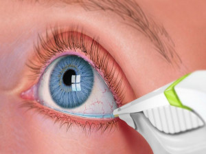 علت مثبت و منفی بودن EYE Discharge در آزمایش ترشحات چشمی