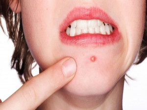 درمان های خانگی برای جوش های خونی کدامند ؟