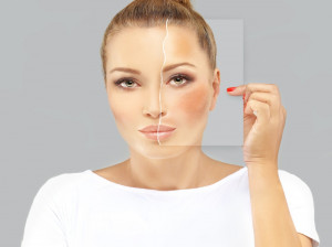 ملاسما یا ماسک بارداری چیست ؟
