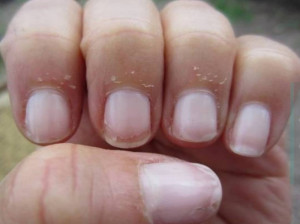 پوسته پوسته شدن اطراف ناخن نشانه چیست ؟