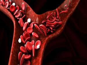 علائم کم خونی داسی شکل چیست و چگونه درمان میشود ؟