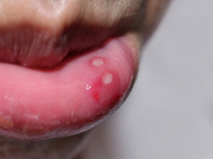 زخم دهان : ۱۵ روش خانگی درمان زخم و یا آفت دهان