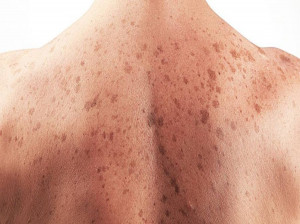 انواع سرطان پوست کدامند و چگونه ایجاد میشوند ؟