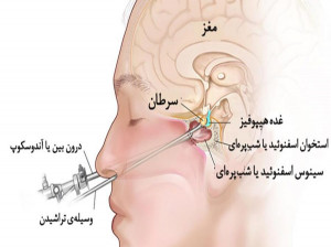 تومور هیپوفیز چیست + درمان تومور هیپوفیز