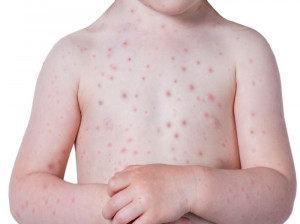 تعبیر دمل و آبله در خواب چیست ؟