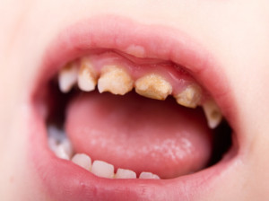 علت سیاه شدن دندان کودکان چیست؟ راههای پیشگیری و درمان