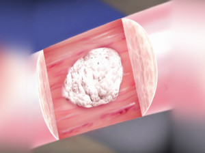 کلسیفیکاسیون پستان چیست و چگونه درمان میشود؟
