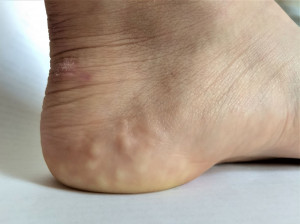 برجستگی های سفید روی پاشنه