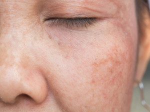 بهترین راهکار برای از بین بردن جای لکه های پیگمانته از روی پوست