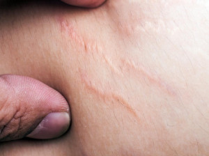 دلیل کشیدگی پوست بدن چیست؟