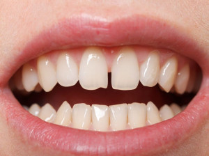 فاصله بین دندانی یا دیاستما چیست؟