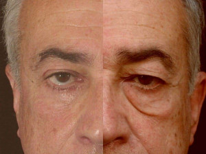 بلفاروپلاستی (جراحی پلک) چیست؟ چه عوارضی دارد؟