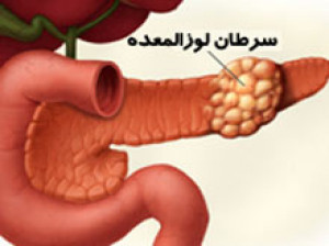 سرطان لوزالمعده؛ علائم و درمان