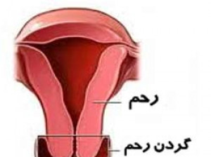 زخم دهانه رحم در خانمها