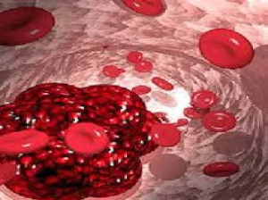 آمبولی مایع آمنیوتیک وانسداد رگهای مادر در موقع زایمان