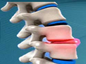 آرتروز و شیوه ی درمان آن؟