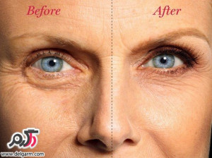 دلیل و رفع پف دور چشم ها با روش های طبیعی