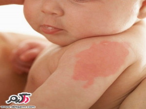 ماه گرفتگی پوست یا ضایعات روی پوست ؟